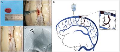 Impacts on Thrombus and Chordae Willisii During Mechanical Thrombectomy in the Superior Sagittal Sinus